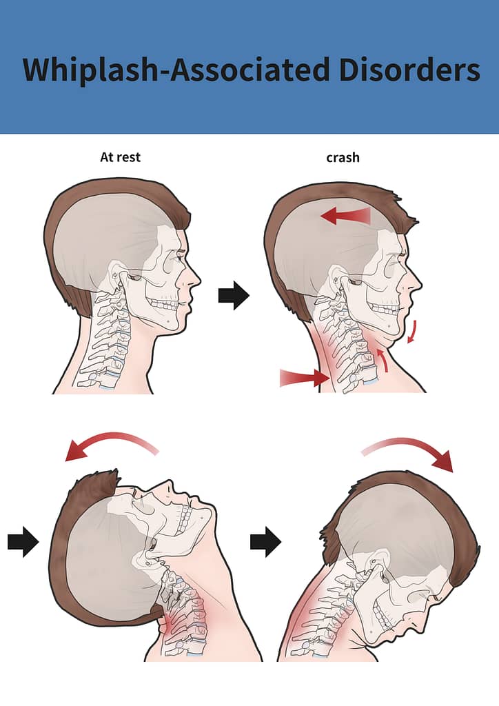 The Whipping Motion of The Neck Puts Upper Neck At Risk