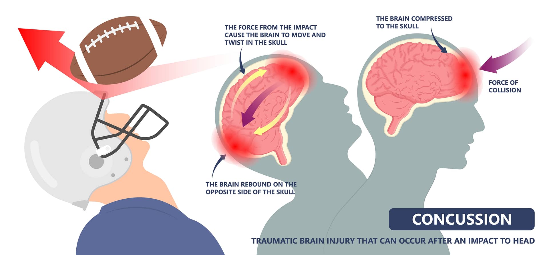 Post-Concussion Brain Fog